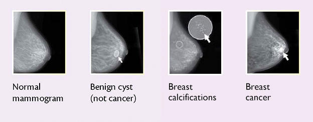 Breast cancer lump painful