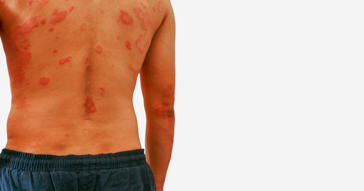 Man's back covered in a rash