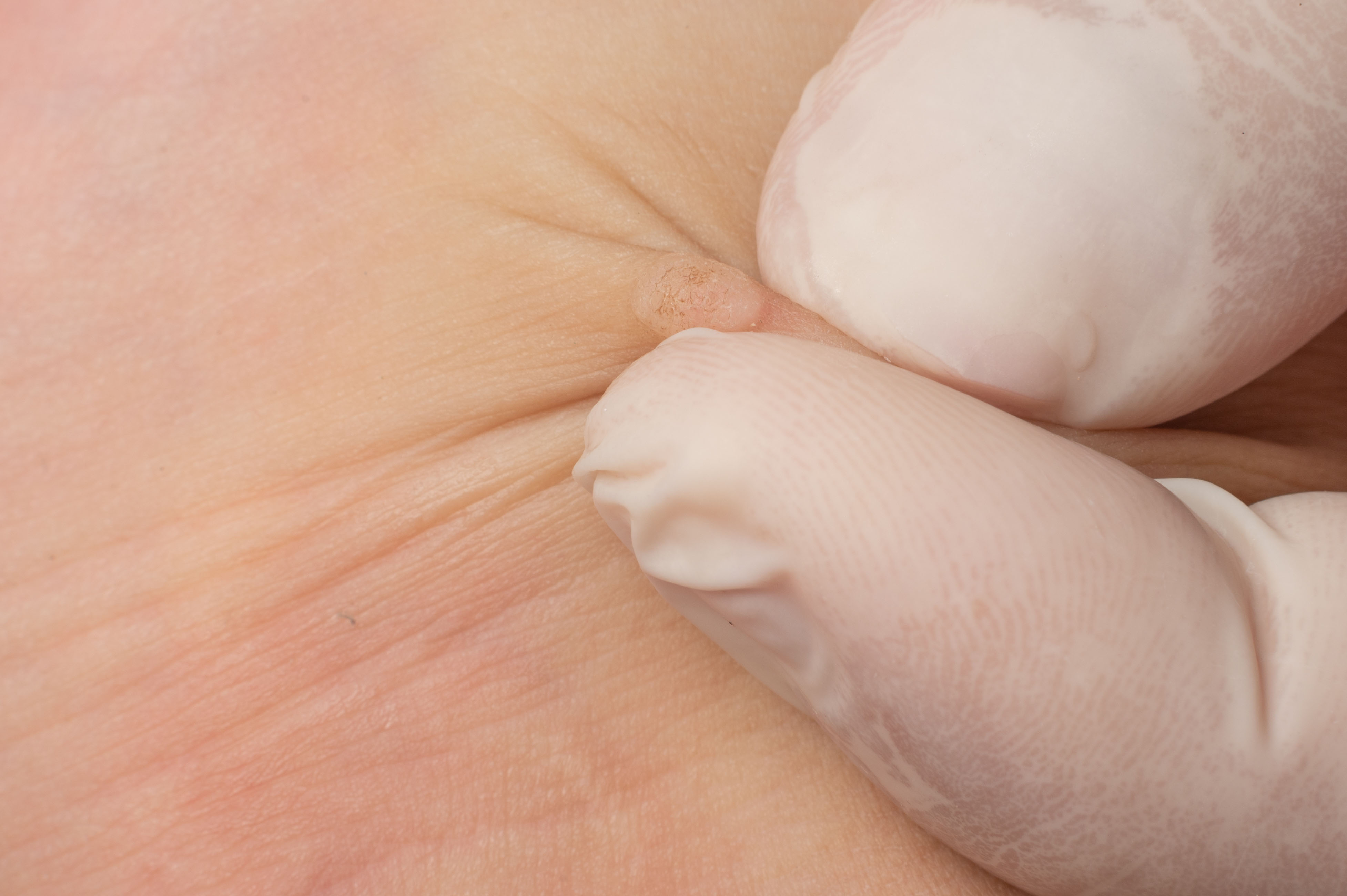 How to identify and treat common warts