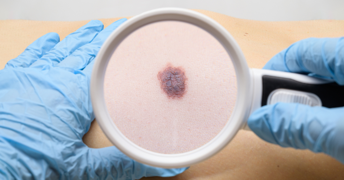 Advancing Health webinar Identifying suspicious moles and when to see