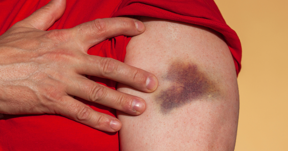 Swelling and bruising: How long will it last?