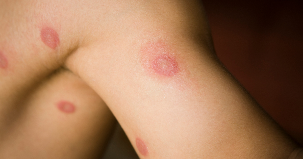 Close up of a person's skin with ringworm