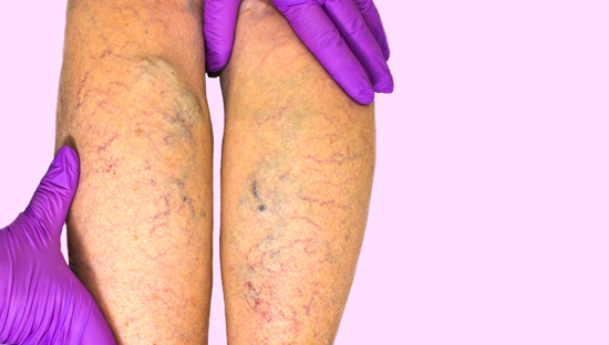 picture of a doctor examining a patient's varicose veins