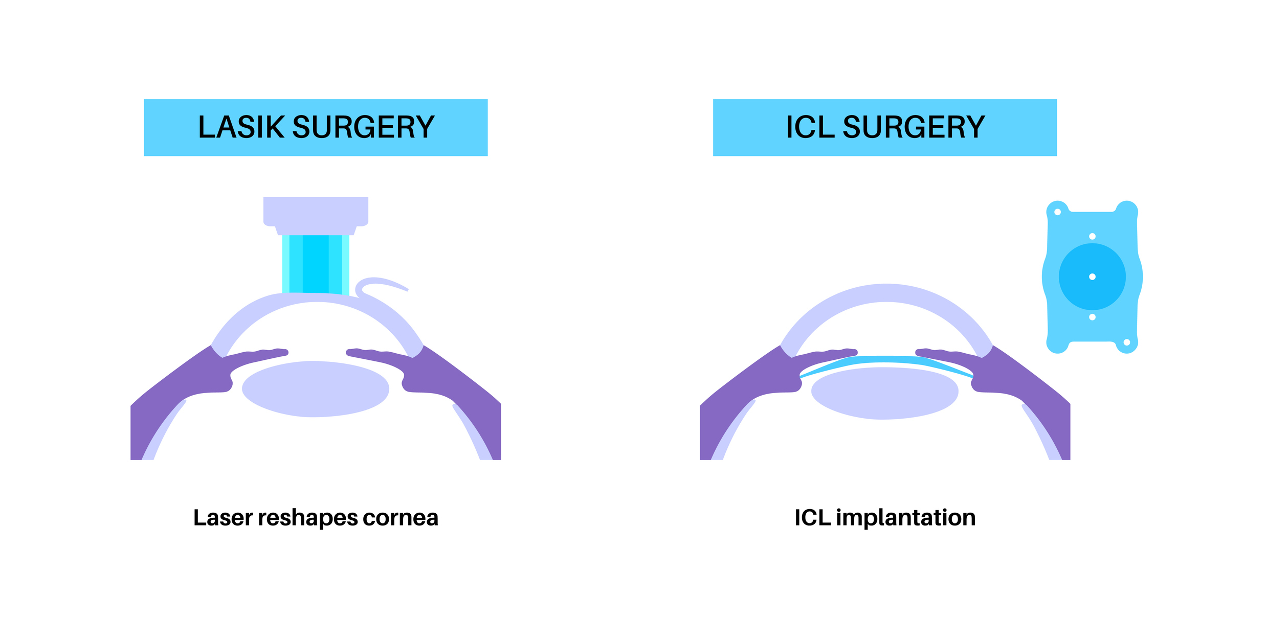 Medical illustration showing the difference between LASIK surgery and ICL surgery