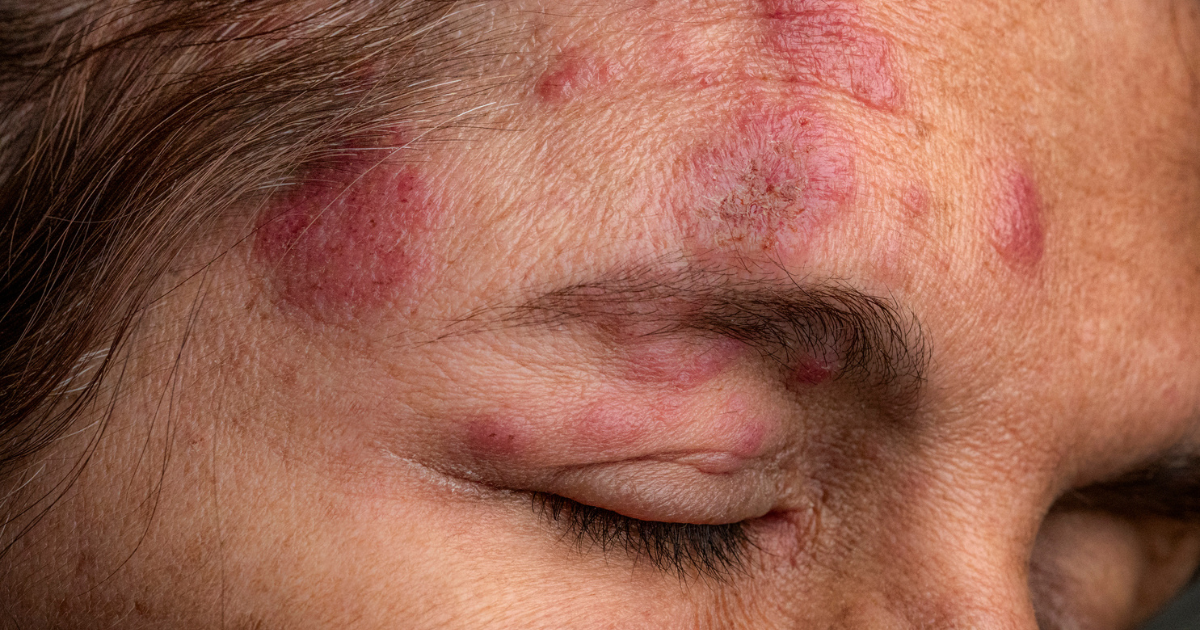 Close up of woman with ocular shingles