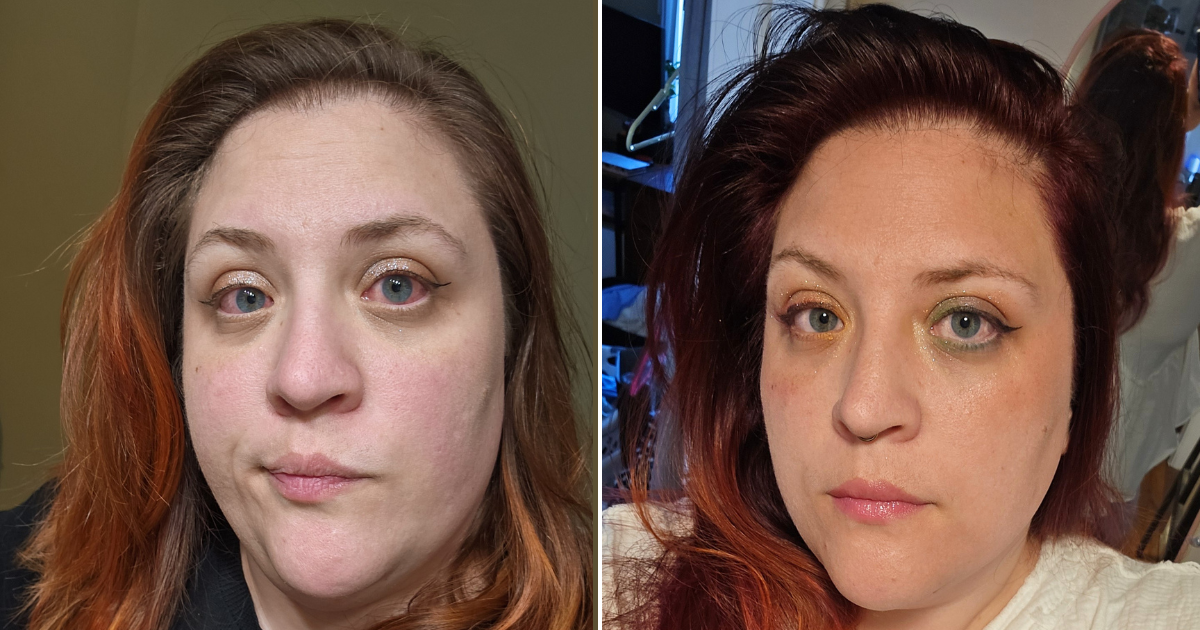 After years of severe dry eye symptoms, a patient finally finds relief