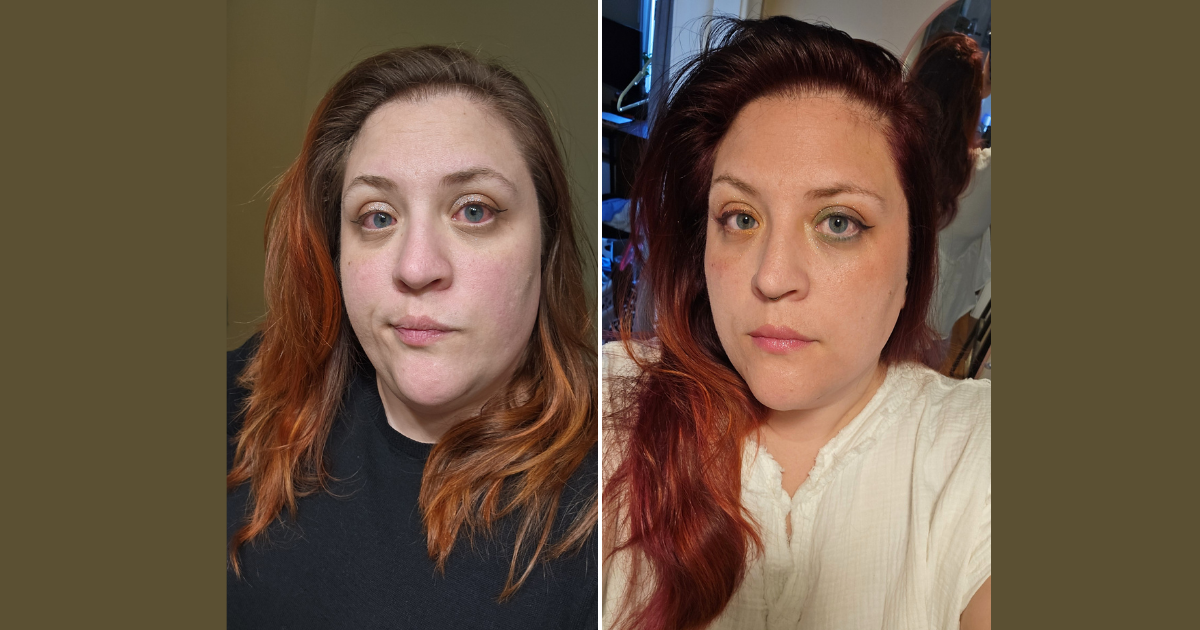 Erin Solheim before and after treatment