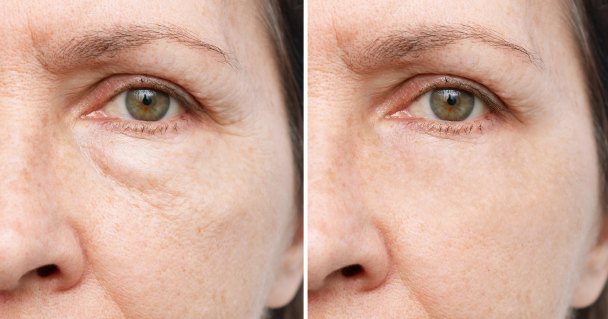 Before and after photo of eye rejuvenation