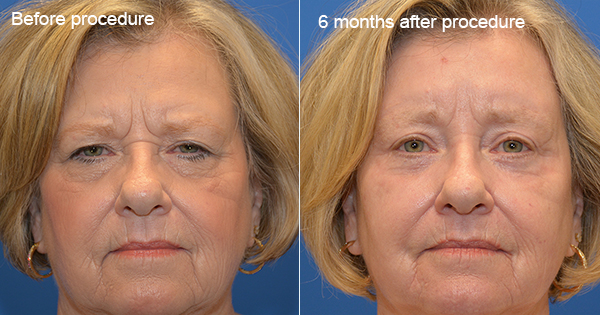 How to Get Rid of Scars for Good
