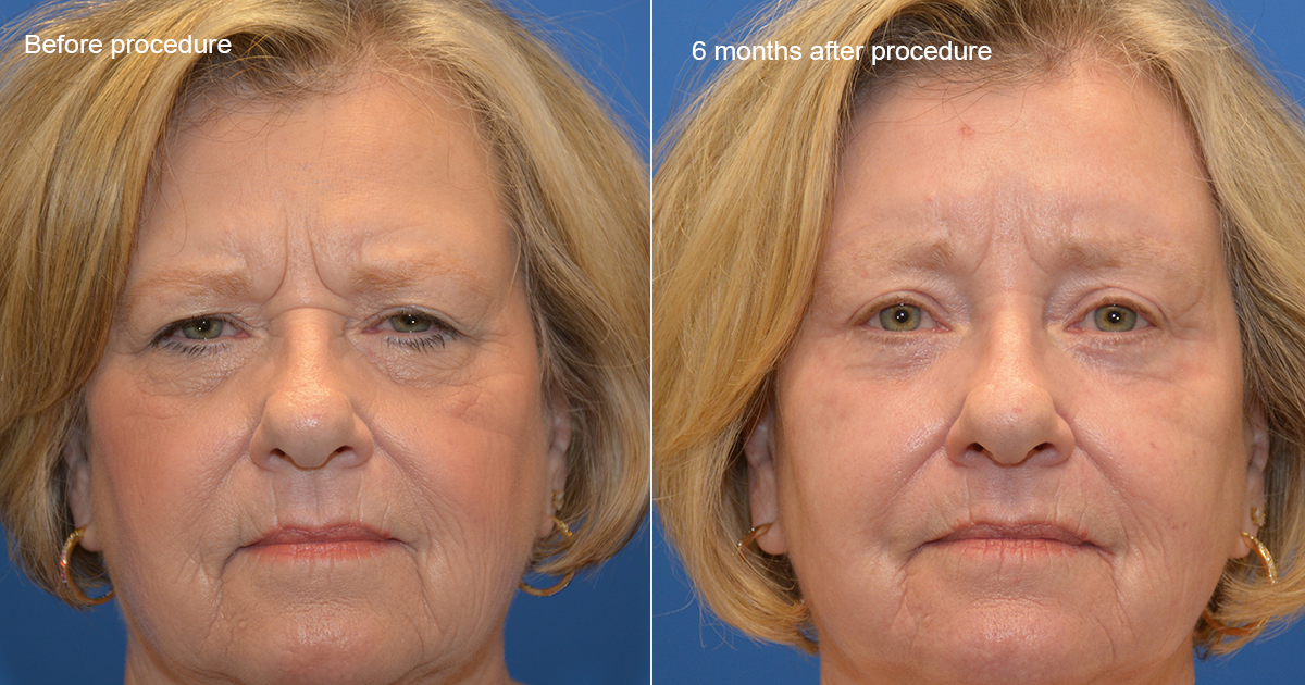Woman before and after facial resurfacing