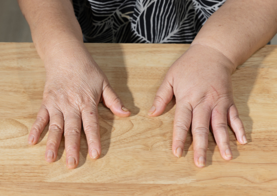Close up of woman's hands on table, right hand and arm swollen