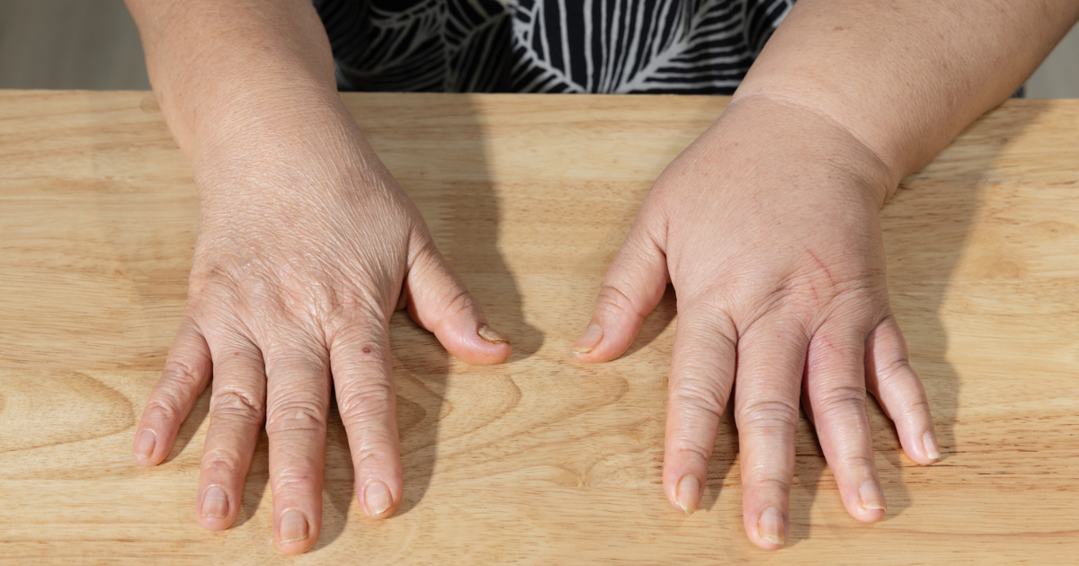 The state’s only Comprehensive Cancer Center of Excellence for lymphedema