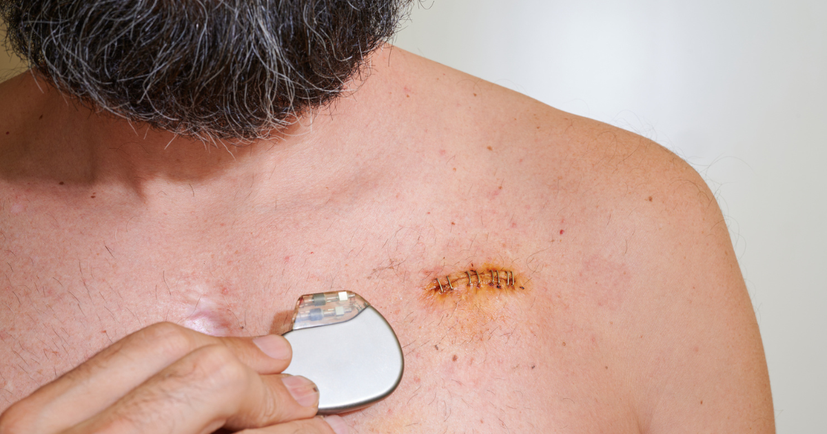 Man holding a pacemaker over a scar on his chest