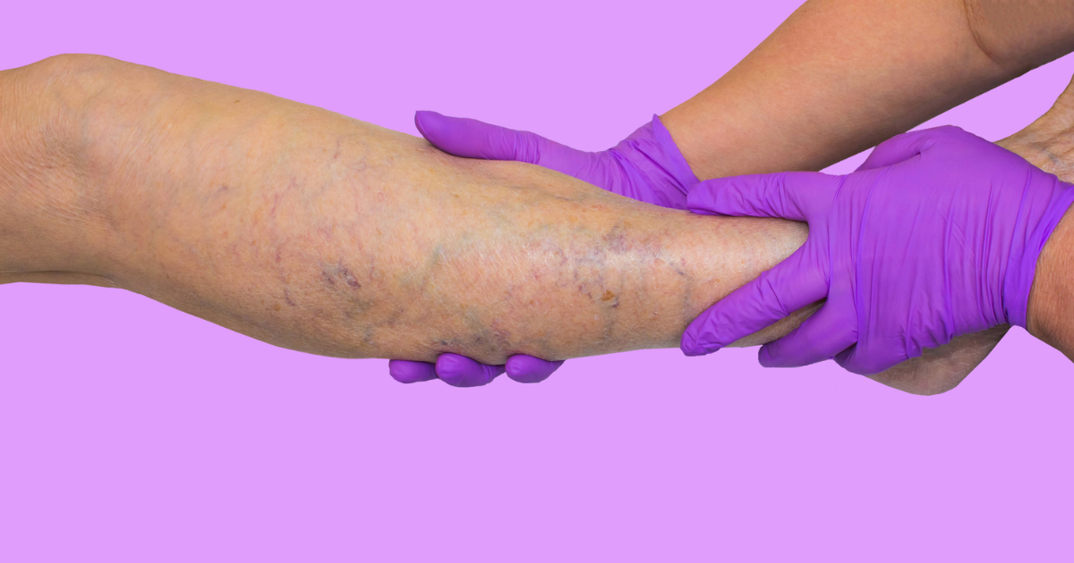 Leg with venous insufficiency