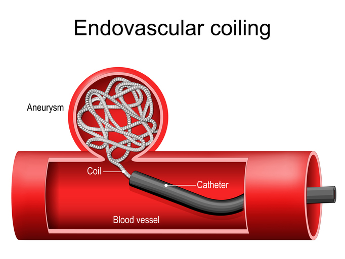 Endovascular coiling of aneurysm.