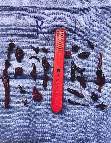 16 blood clots removed from Raihanna's body