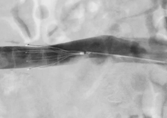 IVC filter
