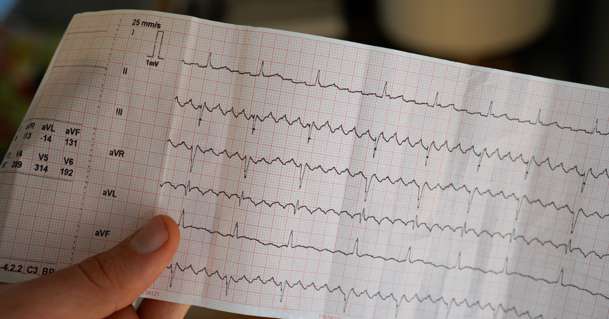 Pulsed field ablation: A paradigm shift in AFib treatment