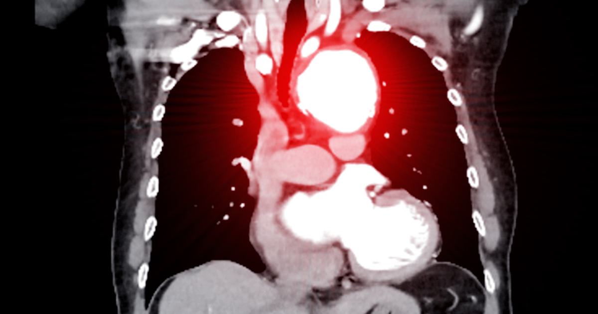 Scan of aortic aneurysm