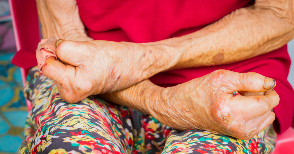 Close up of an old woman's hands affected by leprosy