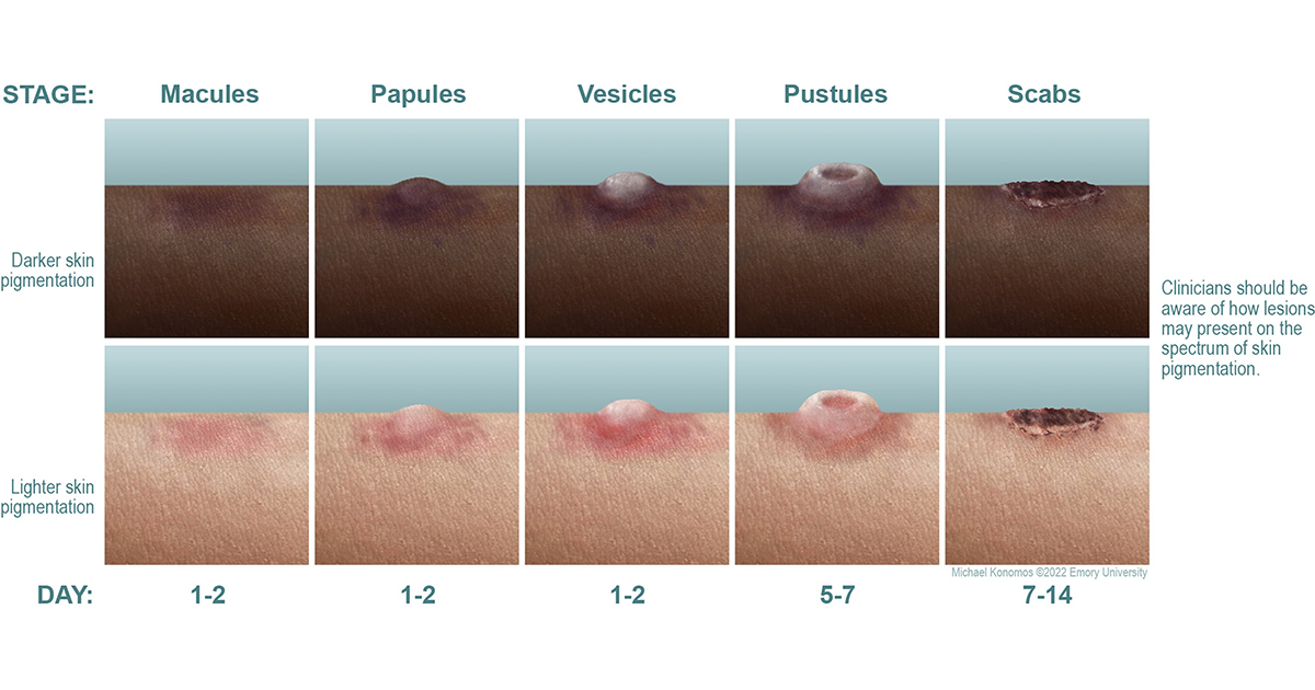 Monkeypox progression visual