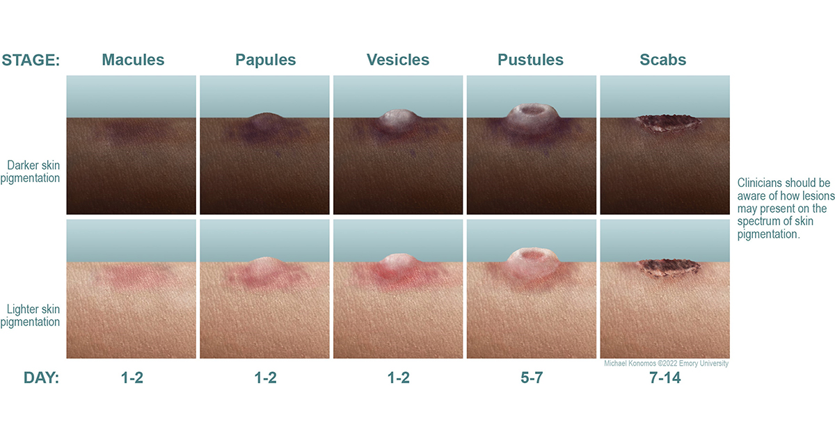 How does monkeypox start? Plus, 5 pictures to show how the bumps progress