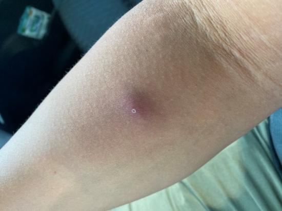 Can monkeypox cause keloid scars?