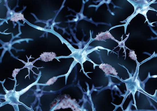 3D illustration of amyloid plaques