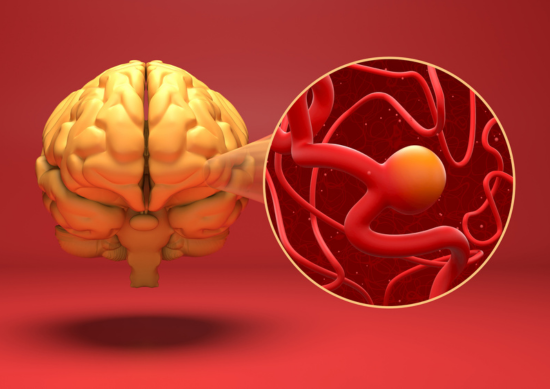 Medical graphic of unruptured brain aneurysm