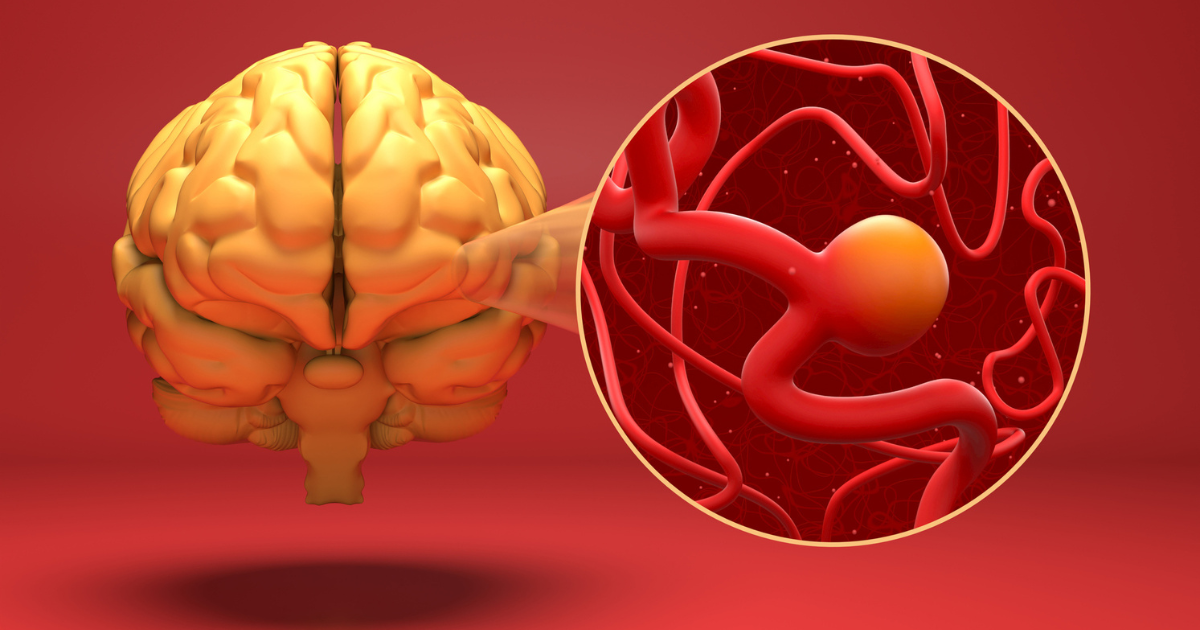 Managing unruptured intracranial aneurysms: Balancing risk, evidence and individualized care