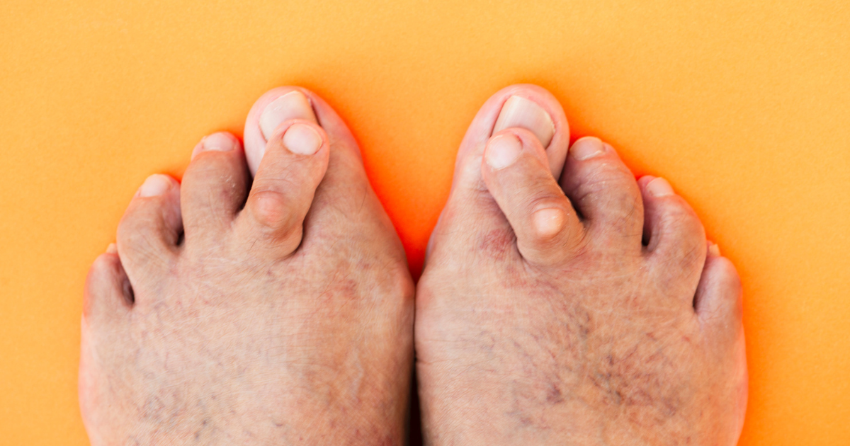 Close up of man's feet with hammertoes