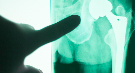 picture showing an xray of a hip replacement