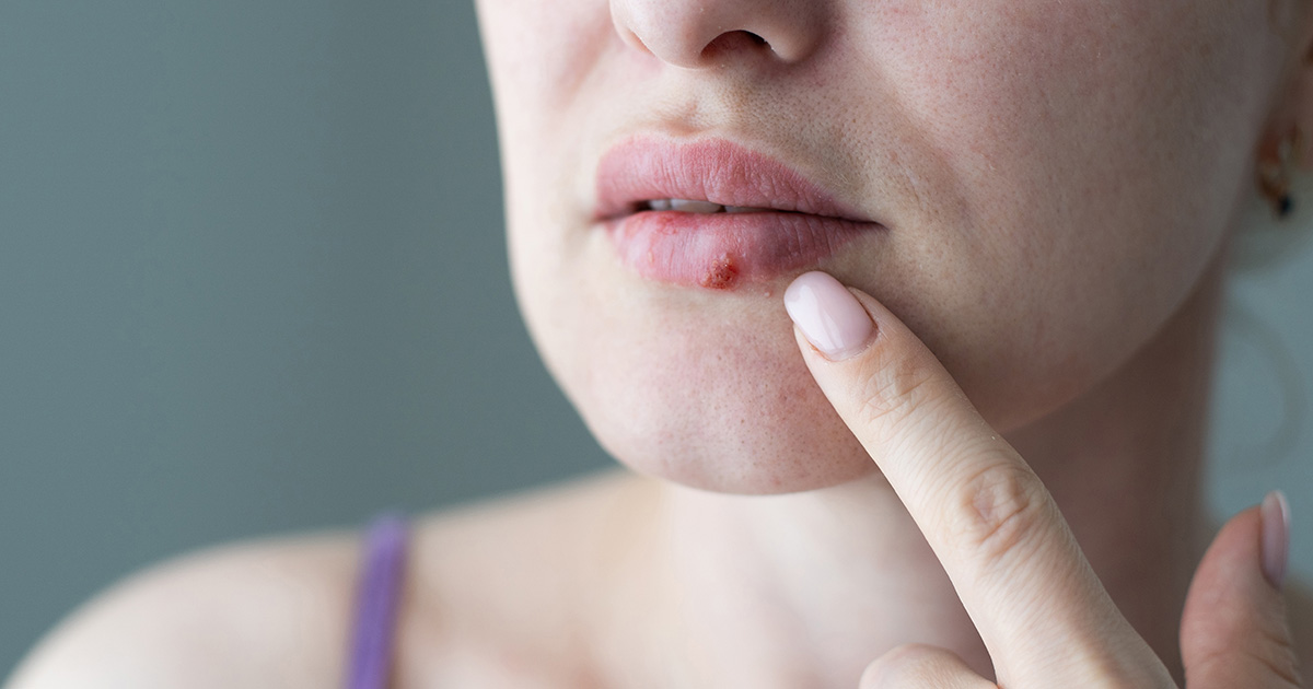 picture of a woman with a cold sore