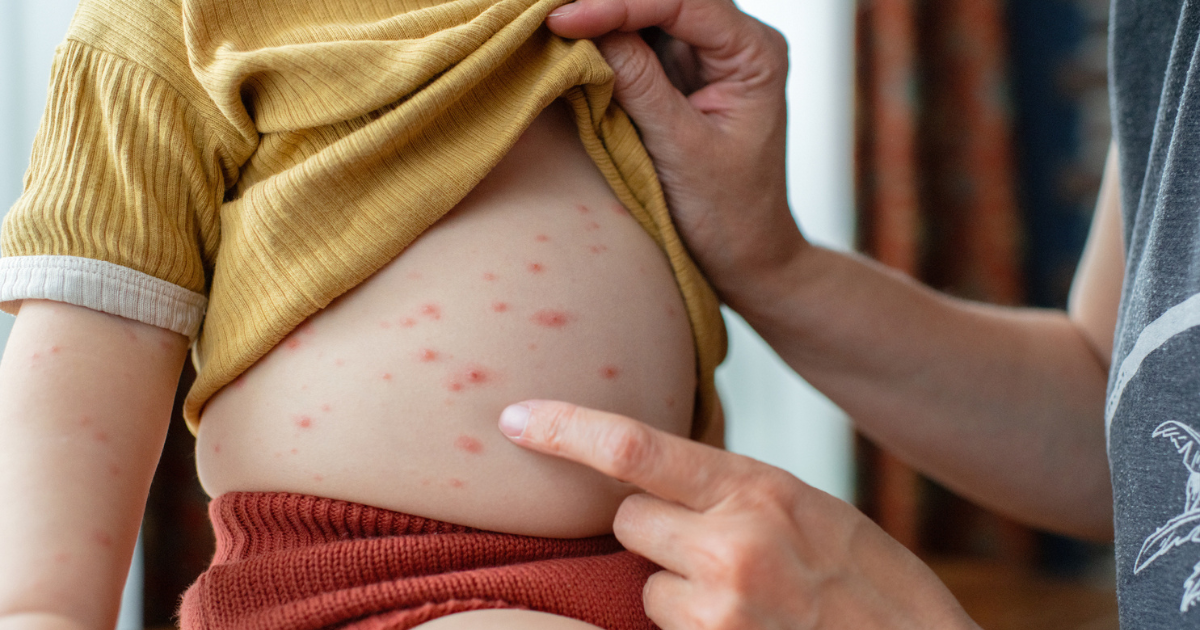 Close up of mother looking at child's stomach with chickenpox