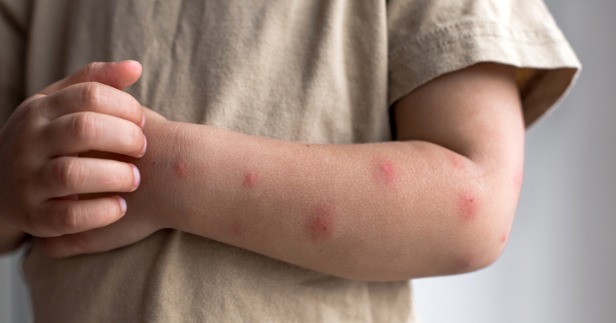 Close up of child's arm with rash