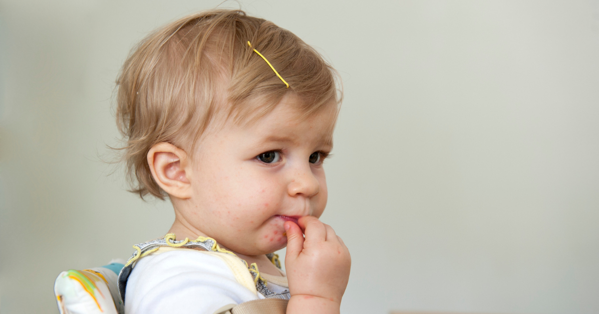 Young girl with hand, foot and mouth disease