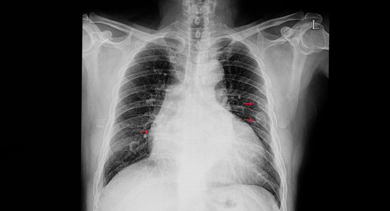 Xray image of broken ribs 