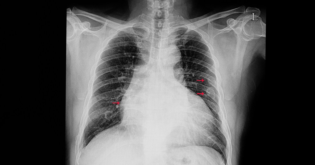 X-ray of broken rib