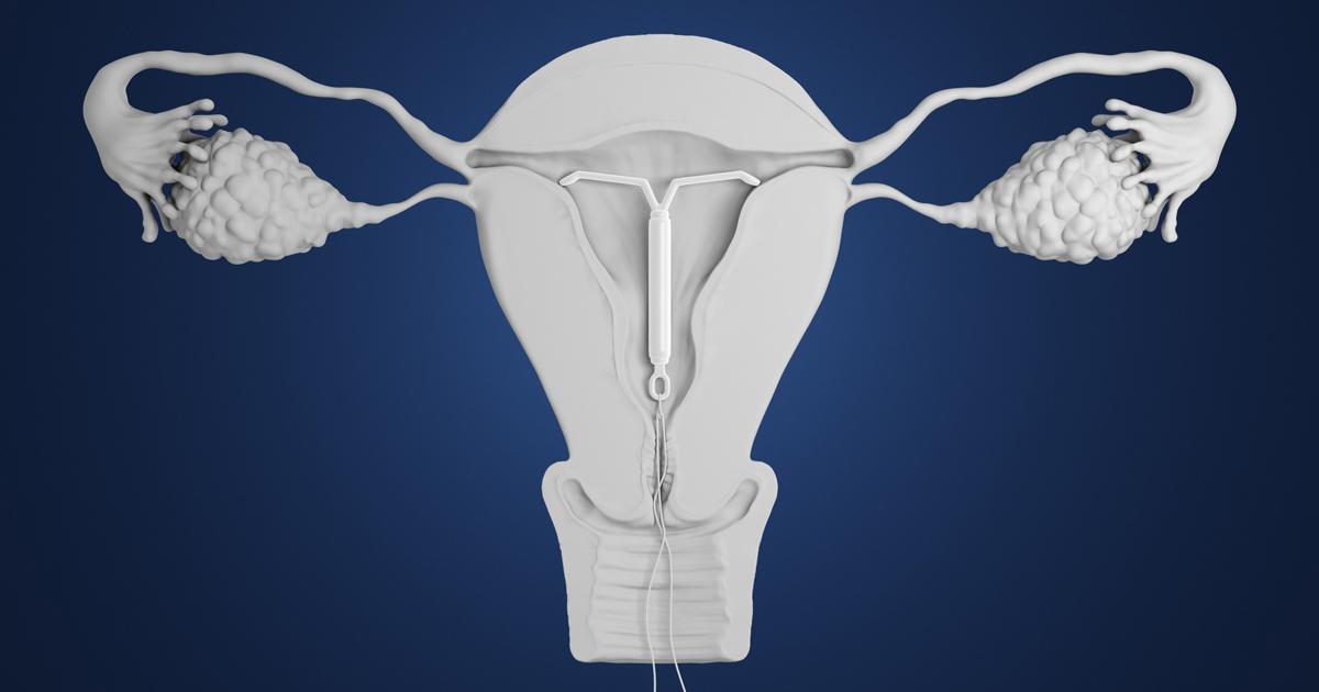 Bedsider Iud