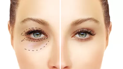 Eyelid surgery can eliminate droopy eyebrows, saggy eyelids and baggy eyes.