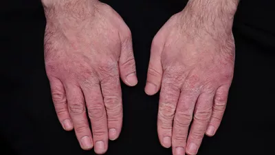 Hands with chapped skin. 