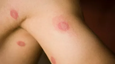 picture of a person with ringworm lesions