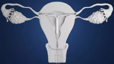 3d rendering of an IUD