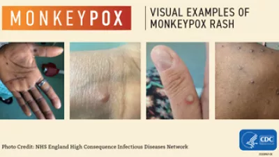 Monkeypox | Visual examples of monkeypox rash | Photo credit: NHS England High Consequence Infections Diseases Network | CDC CS328947-EK
