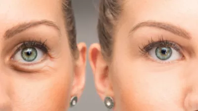 before and after of eyelid surgery