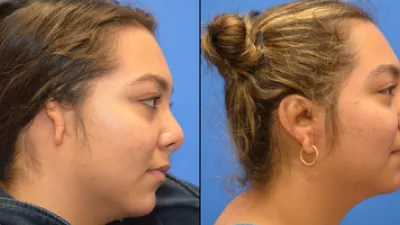Before and after of woman with congenital ear deformity (microtia)