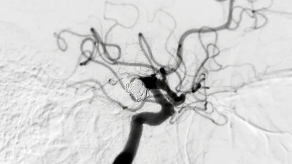 Endovascular coiling during a cerebral angiogram shows the precision required for treating vascular conditions.