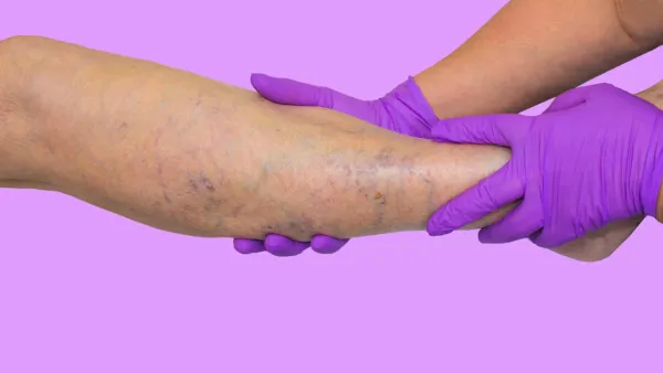 Leg with venous insufficiency