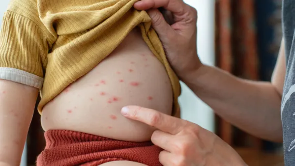 Close up of mother looking at child's stomach with chickenpox