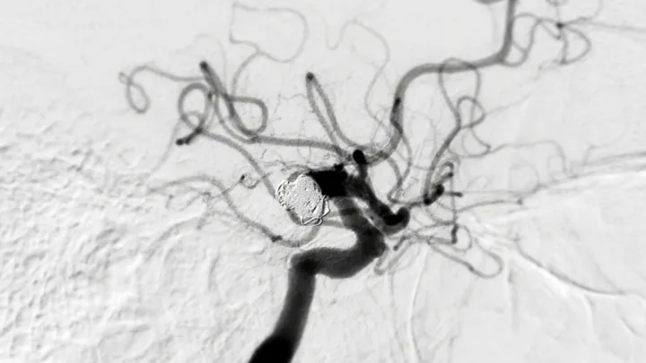 Endovascular coiling during a cerebral angiogram shows the precision required for treating vascular conditions.